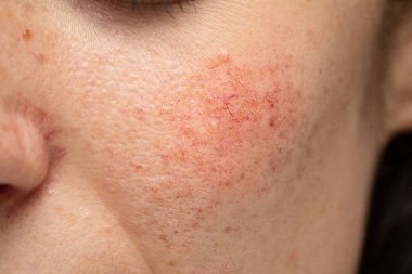Kırmızı yanaklı, genç, beyaz bir bayanın yanağına yakın çekim görüntüsü. Genç yetişkinlerde rosacea ve dermatitin yaygın bir belirtisidir..