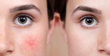 Kafkasyalı genç bir kız, rosacea belirtilerini ortadan kaldırmak için yoğun hafif ameliyat sonuçlarını gösteriyor. Yanak kızarıklığında gözle görülür bir azalma görüldü.