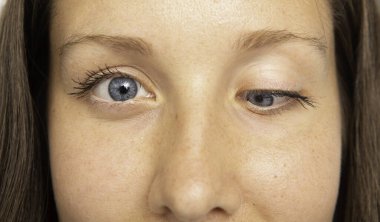 Strabismus hastası genç bir kadın, göz hastalığı var.