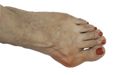 Yaşlı bir kadının çıplak ayağına yakın çekim, acı verici ve şişmiş bir hallux valgus vakası gösteriyor, kırmızı ve iltihaplı beyaz arka planda izole edilmiş..