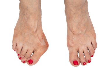 A closeup view on the feet of an older woman with red painted toenails. Deformation of the big toe is seen with a large bunion. Shot against a white backdrop. clipart