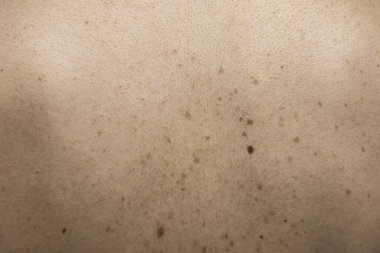 Pigmentasyon lekeleri ve cilt üzerinde doğum lekeleri yakın çekim