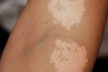 Tinea versicolor, malassezia globosa mantarı enfeksiyonundan muzdarip bir kişinin koluna yakından bakmak cilt renginin bozulmasına neden olur..