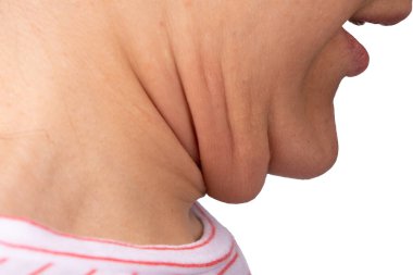 Kafkas bir kadının yakın plan ve yan profili çenesini göğsüne doğru indiriyor ve boynundaki gevşek ve sarkık deriyi gösteriyor. Genellikle hindi boynu denir..