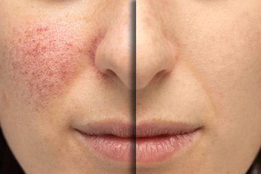 Rosacea 'dan muzdarip genç beyaz bir kadının yanaklarına yakından bakmak. Lazer ameliyatından önce ve sonra kusurları gidermek için..