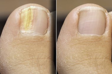 Ayak tırnağındaki mantar enfeksiyonu için başarılı bir tedavi öncesi ve sonrası.