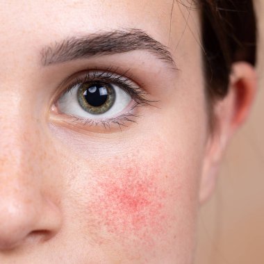 A young Caucasian girl in her early 20s is seen up close. Details of the green iris and eye area. Rosy cheek is seen with small red blotches. Symptomatic of rosacea, a common skin complaint. clipart