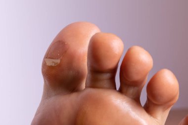 Kafkasyalı bir yetişkinin ayak ve ayak parmaklarında iyileşen kabarcık ve nasır derisi olan yakın çekim görüntüsü. Kuru ve ölü derinin aşağıda asılı olduğu ve eski yaraların olduğu görülüyor..