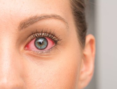 Redness on female eye, macro image clipart