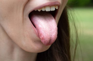 Beyaz dil, sebep ve tedaviler