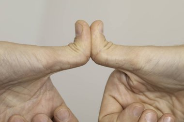 Hypermobile (double-jointed) thumbs are seen close up as a caucasian person shows the flexibility of the thumb joints, bending backwards. clipart