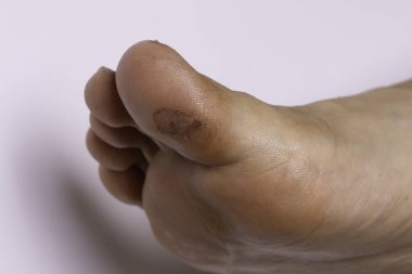 Ayak nasırları, ayak parmağı nasırları