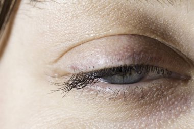 Kadın gözünün ptosis ile kapatılması: sarkık göz kapağı, amblyopia co