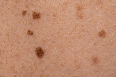 Beyaz tenli iyi huylu nevi bir makro görünüm. Açık tenli sivilceler, güzellik lekeleri ve saç folikülleri. Kanser ve dermatoloji kavramları.