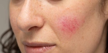 Woman with blotchiness on the cheek caused by bacterial infectio clipart
