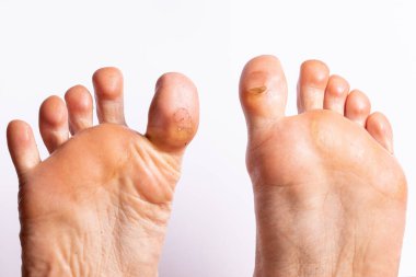 Nasırlı dansçı ayakları, soyulmuş ve kırılmış kabarcıklar.