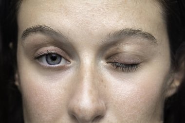 Bir gözü yakın, acı verici, kırmızı ve bir hordeolum (stye) yüzünden şişmiş, yaygın bir bakteri enfeksiyonu olan beyaz bir kızın gözlerine yakından bakmak..