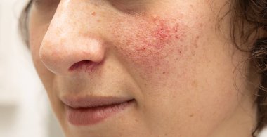 Yanaklarında ve burnunun altında rosacea olan genç bir kadının yakın plan görüntüsü. Kırmızı lekeler ve belirgin kan damarları ayrıntılı olarak görülüyor..