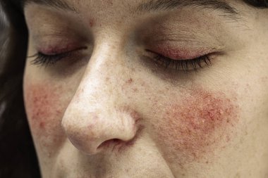 A close up view on the face of a young caucasian lady, suffering from a severe case of rosacea, with facial redness and dilated blood vessels of the eyelids, nose and cheeks. clipart