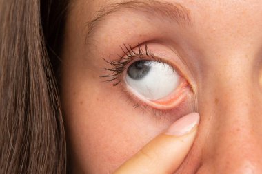 Güzel, genç, beyaz bir kadın göz kapağını aşağı indirir ve tavana doğru bakar. Gözün beyazlarını ortaya çıkarmak için. Yabancı cisimler ve hastalık belirtileri kontrol ediliyor.