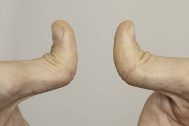 Çift eklemli bir insanın başparmaklarında aşırı yakın çekim görüntüsü, iskelet el eklemlerinde hiperhareketlilik, baş parmakları geriye eğme yeteneği.