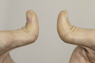 An extreme closeup view on the thumbs of a double jointed person, hypermobility in the skeletal hand joints, ability to bend thumbs backwards. clipart