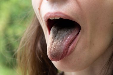 A girl with a black furry tongue is viewed closeup. Symptoms of enterobacter cloacae bacteria infection. Copy space on the left. clipart