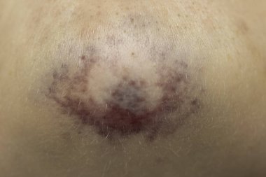 Çenesi morarmış, derisi tahriş olmuş. Yakın görüş.