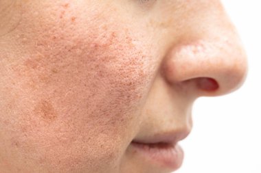 Kafkasyalı genç bir kadının yanak ve burnunda kenar ve profil görüntüsü. Rosacea belirtilerini ortadan kaldırmak için lazer ameliyatı yaptıktan sonra kızardı ve kızardı..