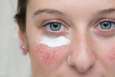 A closeup view of a pretty caucasian girl with topical cream below the eye, over red blotchy cheek, topical ivermectin and azelaic acid cream treat rosy cheeks. clipart