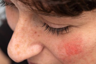 Kırmızı yanaklı, beyaz bir kadının yüzüne yüksek açılı bir bakış açısı. Rosacea belirtileri, genç yetişkinlerde yaygın bir cilt şikayetidir..