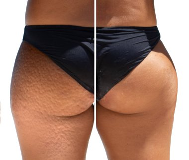 Siyah bir bikini giyen güzel bir kadının belinin altındaki adiposis ödemini almak için yapılan başarılı topikal krem ve ultrason tedavilerinden önce ve sonra beyaz bir arka planda izole edilmiş..