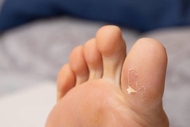 İnsan ayağının altında yakın plan bir görüntü var. Dökülme ve ölü derinin detayları büyük bir iyileşme kabarcığından..