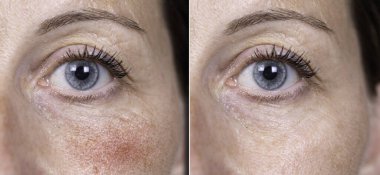 Kırk yaşında beyaz bir kadının mavi gözüne yakından bakmak başarılı cerrahi müdahalenin sonuçlarını üst yanaktaki Rosacea belirtilerini ortadan kaldırmak için gösteriyor..
