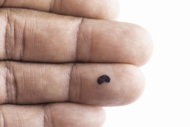 Nevus sol tarafta. Yıllığı kapat.