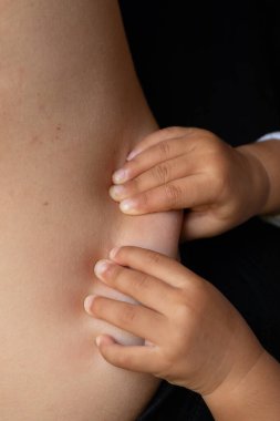 Anne vücudunda fazla deri tutan bir çocuk.