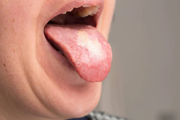 若い大人の口の中に極端なクローズアップビュー 右側のコピーのための部屋で カンジダ症の経口酵母の感染症を明らかにするために彼らの舌をスティック — ストック写真