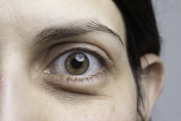Uma Visão Perto Olho Verde Uma Jovem Caucasiana Que Sofre — Fotografia de Stock