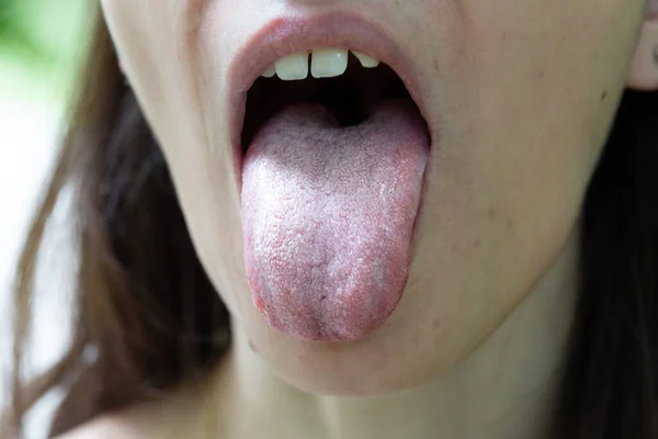 一个30多岁的白人女孩的舌头上露出了一个特写镜头 可见白色包衣 有口腔溃疡的症状 是成年人常见的酵母感染 — 图库照片