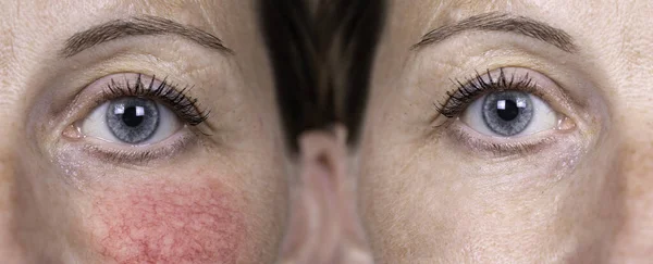 A mature caucasian woman in her early 40s shows the before and after results of successful treatment for rosacea, superficial blood vessels and rosy cheeks have diminished.