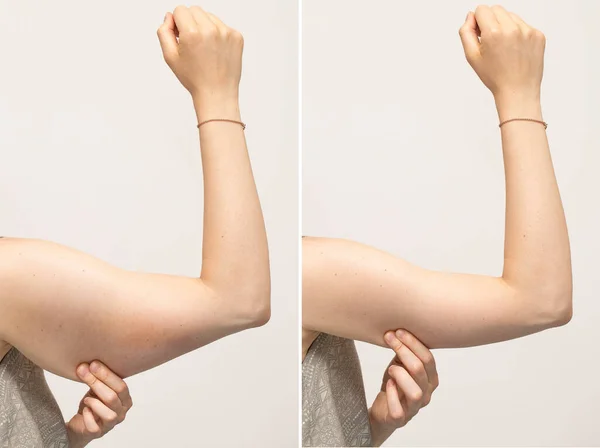 Rozszczepiony Ekran Kobiety Ściskającej Skórę Pod Ramieniem Pokazuje Przed Wynikach — Zdjęcie stockowe