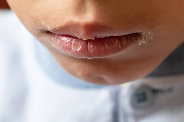 A closeup view on the painful and blistered lips of a young child. Dry and cracked skin is seen at the sides of the mouth with sore spots on the tender lips.