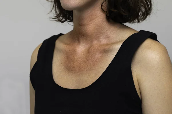 A close up and front view of a young caucasian woman wearing a black vest top to reveal severe redness and tan line from spending too much time in summer sun.