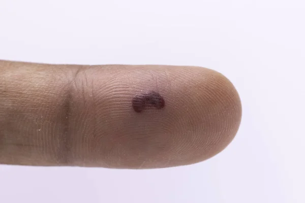 An extreme closeup and macro view on the index of a caucasian finger, isolated against a white background, injured with blood blister, a bloody lymph poll beneath the delicate skin.