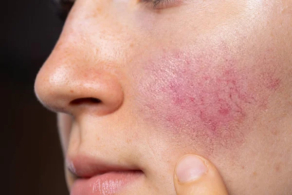 Genç beyaz bir bayan, kırmızı yanaklarını işaret ederek yakından görüldü. Genç yetişkinlerde Rosacea 'nın yaygın bir belirtisidir. Boşluğu sağda kopyala.