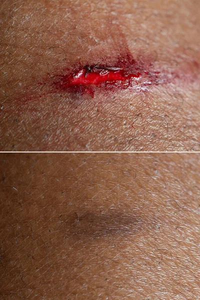 Superficial wound before and after a connective tissue treatment