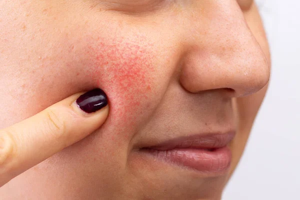 Genç, beyaz bir kadın, kırmızı yanağını işaret ederek yakından görülüyor. Rosacea 'nın yaygın bir belirtisi. Yüzeysel genişlemiş kan damarları yüzde ayrıntılı olarak görülüyor..