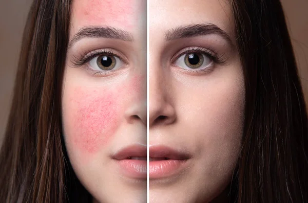 Rosacea 'dan muzdarip beyaz güzel bir kızın öncesi ve sonrası. Başarılı lazer ameliyatının sonuçlarını gösteren portre görünümü