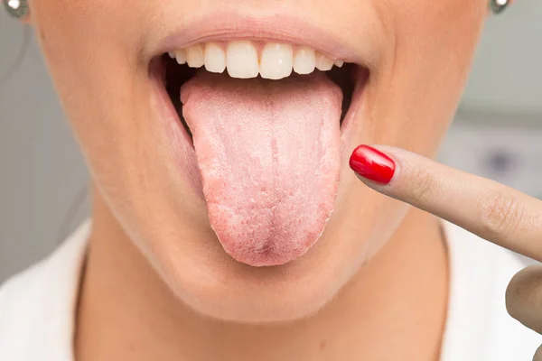 Woman Having Candidiasis Pointing Her Tongue Finger — Stock Photo, Image