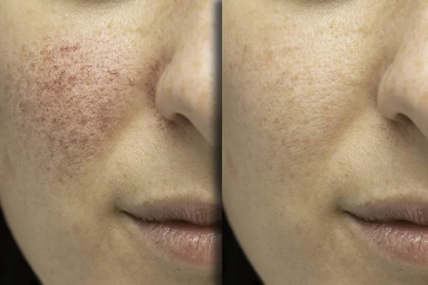 Rosacea 'nın yüzünden alınması için yapılan tedavi öncesi ve sonrası.